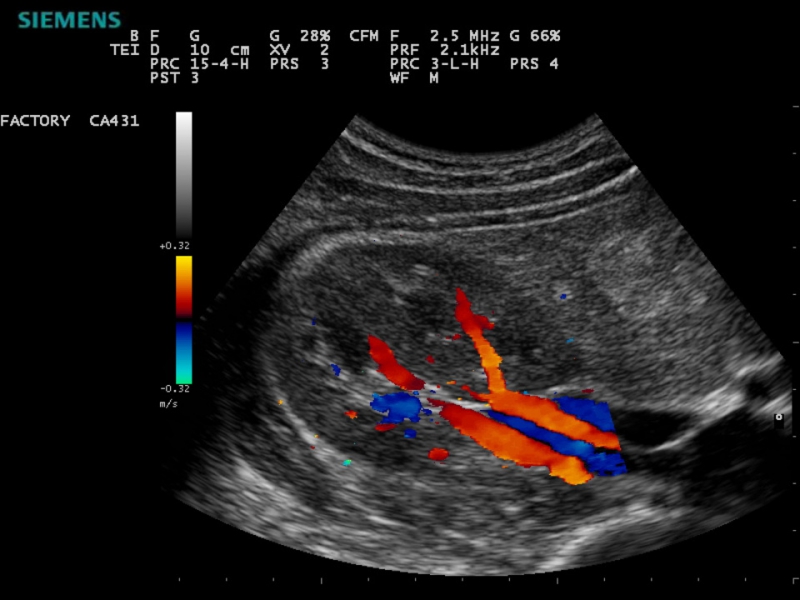 abdominal-doppler-liver-aorta-renal-centro-sononuclear-rio-piedras