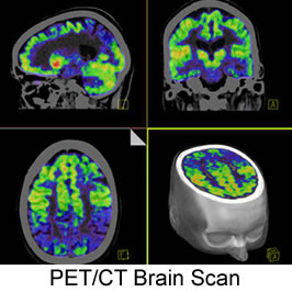 Pet Scan